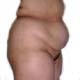 One Of Dr Di Saia's Patients Before Her Tummy Tuck.