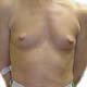 One Of Dr Di Saia's Patients Before Her Breast Augmentation.