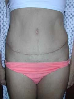 Extended Skin Tummy Tuck After 3 Months