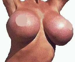 huge breast implants