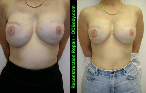 Before and Nine Months after Repair of Reconstructive Breast Implant Case