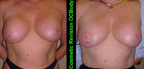 Before and Two Months after Repair of Cosmetic Breast Implant Case