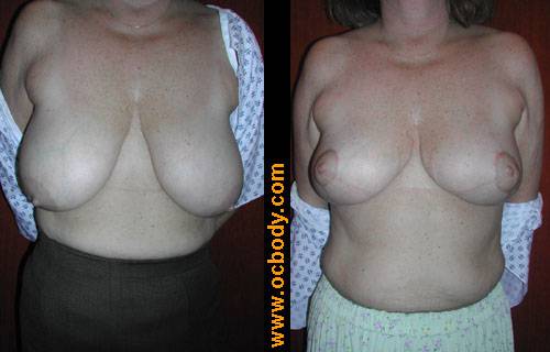 orange county breast reduction before after