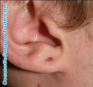 Ear Plug Hole Repair Before