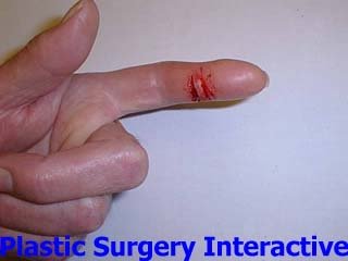emergency plastic surgery hand case