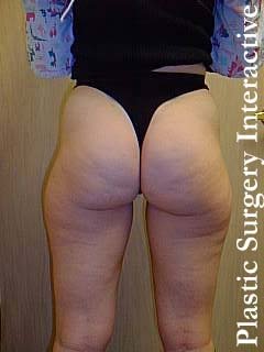 Lateral Thigh and Banana Roll Liposuction