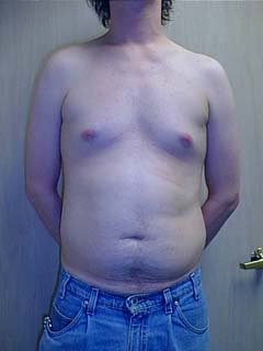 Man Before Belly Liposuction