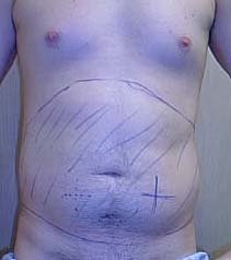 Man Marked Before Belly Liposuction