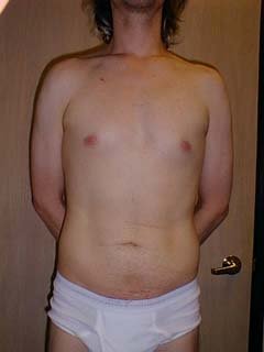 Man 2 Months After Belly Liposuction