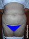 Moderate Frame Extended Tummy Tuck