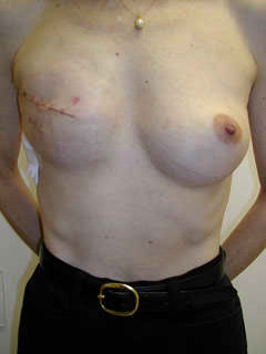 2 Weeks After Mastectomy and Placement Tissue Expander