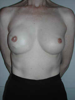 1 Month After Stage III Nipple Reconstruction